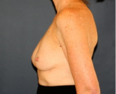 Feel Beautiful - Deflated Left Implant Replacement 412 - Before Photo